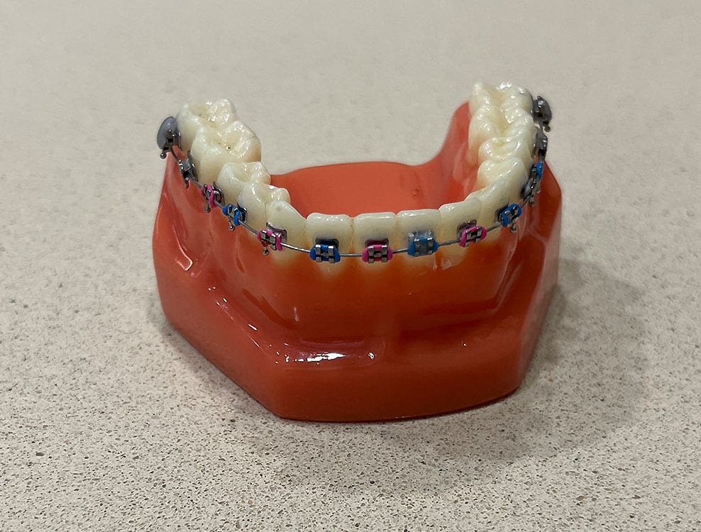 Types of Braces Parkland Coral Springs and Boca Raton FL